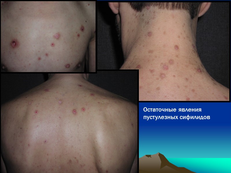 Остаточные явления пустулезных сифилидов